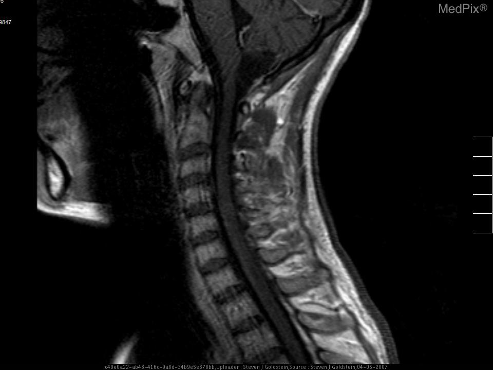 X-ray of a patient with neck pain